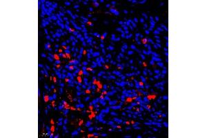 Immunofluorescence of paraffin embedded human liver cancer using AHSG (ABIN7073021) at dilution of 1:650 (400x lens) (Fetuin A 抗体)