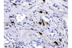 CPB2 was detected in paraffin-embedded sections of human lung cancer tissues using rabbit anti- CPB2 Antigen Affinity purified polyclonal antibody (Catalog # ) at 1 µg/mL. (CPB2 抗体  (AA 166-388))