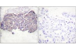 Immunohistochemistry analysis of paraffin-embedded human breast carcinoma, using HSL (Phospho-Ser552) Antibody. (LIPE 抗体  (pSer552))