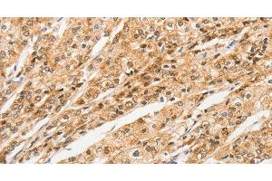 Immunohistochemistry of paraffin-embedded Human prostate cancer tissue using STAM Polyclonal Antibody at dilution 1:40 (STAM 抗体)