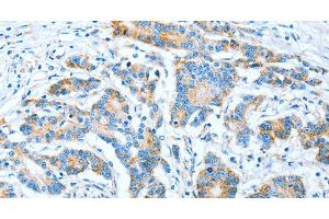 Immunohistochemistry of paraffin-embedded Human colon cancer using IMMT Polyclonal Antibody at dilution of 1:70 (IMMT 抗体)
