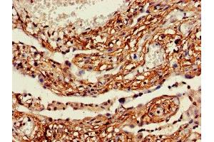 IHC image of ABIN7158511 diluted at 1:600 and staining in paraffin-embedded human lung cancer performed on a Leica BondTM system. (ACSL5 抗体  (AA 33-683))