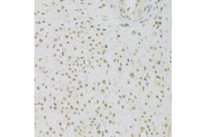 Immunohistochemistry of paraffin-embedded human leiomyoma of uterus using PRPF3 Antibody (ABIN5973192) at dilution of 1/100 (40x lens). (PRPF3 抗体)