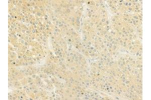 ABIN6259863 and ABIN6279104 at 1/100 staining human hepatocellular carcinoma by IHC-P. (AKR1C4 抗体  (N-Term))