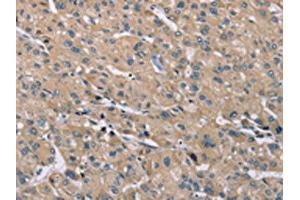 The image on the left is immunohistochemistry of paraffin-embedded Human liver cancer tissue using ABIN7192262(SAMD9L Antibody) at dilution 1/30, on the right is treated with synthetic peptide. (SAMD9L 抗体)