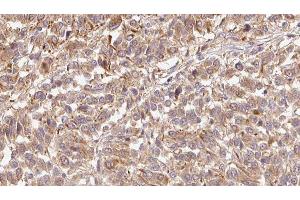 ABIN6279428 at 1/100 staining Human Melanoma tissue by IHC-P. (Fibulin 1 抗体  (Internal Region))
