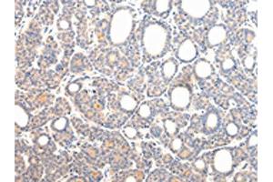 The image on the left is immunohistochemistry of paraffin-embedded Human thyroid cancer tissue using ABIN7131592(VPS54 Antibody) at dilution 1/20, on the right is treated with fusion protein. (VPS54 抗体)