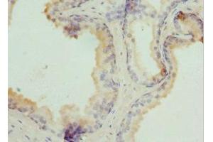 Immunohistochemistry of paraffin-embedded human prostate cancer using ABIN7173912 at dilution of 1:100 (TPD52L1 抗体  (AA 1-144))