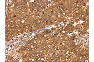 The image on the left is immunohistochemistry of paraffin-embedded Human breast cancer tissue using ABIN7130892(RNASET2 Antibody) at dilution 1/30, on the right is treated with fusion protein. (RNASET2 抗体)