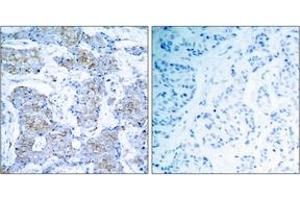 Immunohistochemistry analysis of paraffin-embedded human breast carcinoma tissue, using HER2 (Ab-1248) Antibody. (ErbB2/Her2 抗体  (AA 1206-1255))