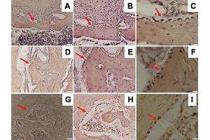 Representative images of immunohistochemical RANKL expression in the mandible of Wistar rats in diabetic group with ×200 magnification (A), ×400 magnification (B), ×1,000 magnification (C); osteoporotic group with ×200 magnification (D), ×400 magnification (E), ×1,000 magnification (F); and control group with ×200 magnification (G), ×400 magnification (H), ×1,000 magnification (I); and RANKL-positive cells were observed (red arrow).