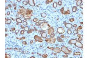 Formalin-fixed, paraffin-embedded human thyroid carcinoma stained with Occludin Mouse Monoclonal Antibody (OCLN/2181). (Occludin 抗体  (AA 282-415))