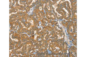 Immunohistochemistry of Human liver cancer using RAB25 Polyclonal Antibody at dilution of 1:40 (RAB25 抗体)