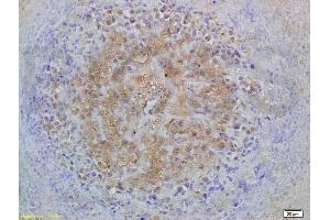 Formalin-fixed and paraffin embedded mouse lymphoma labeled with Anti-Smad3 Polyclonal Antibody, Unconjugated (ABIN747023) at 1:200 followed by conjugation to the secondary antibody and DAB staining (Smad2/3 抗体  (AA 30-80))